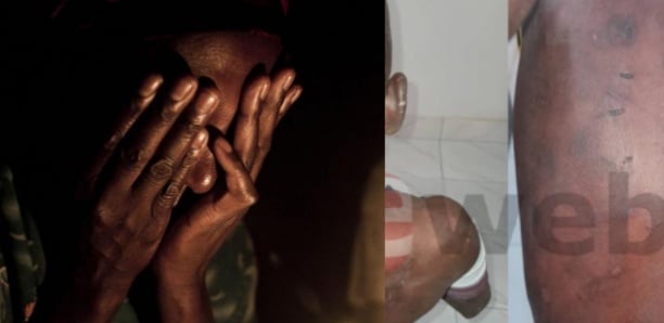 «Elle joue au sexe avec…» : une mère de famille brûle les parties intimes de sa fille de 8 ans et se justifie