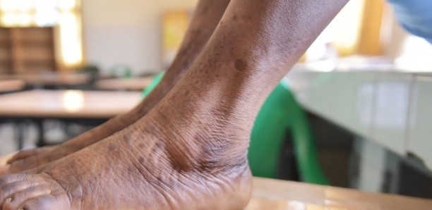 Le taux de dépigmentation au Sénégal n'est pas de 72 % (Africa check)