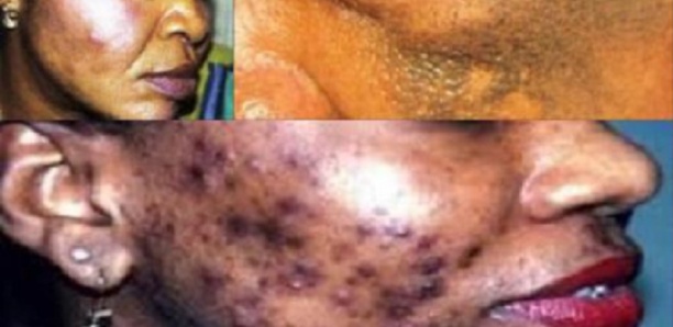 Dr Oumar Seydou Sow : « Les dangers des mélanges de savons et de produits  chez les femmes »