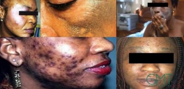 Le taux de dépigmentation au Sénégal n'est pas de 72 % (Africa check)