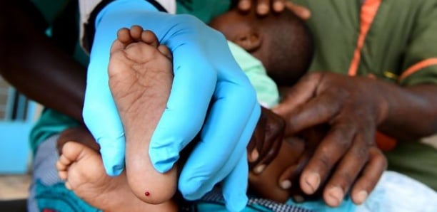 Sédhiou : 66 enfants porteurs du VIH/SIDA