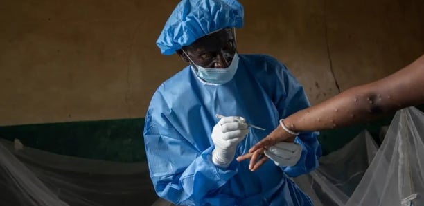 Sierra Leone: plus de 1.100 cas de mpox recensés et 9 décès (autorités)