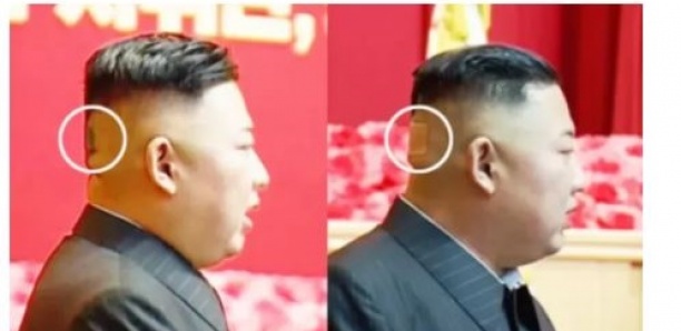 Kim Jong-un vu avec un pansement sur la tête, les rumeurs sur son état de santé reprennent de plus belle