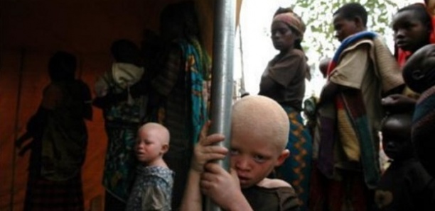 Le corps démembré d'un jeune albinos découvert au Burundi
