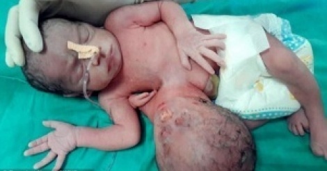 Inde : une deuxième tête retirée du ventre d'un bébé