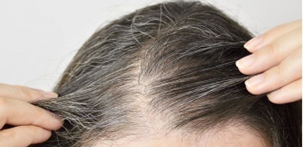 Les infections virales pourraient accélérer l'arrivée des cheveux blancs