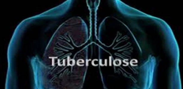 Tuberculose : près de 4500 personnes en meurent chaque jour (OMS)