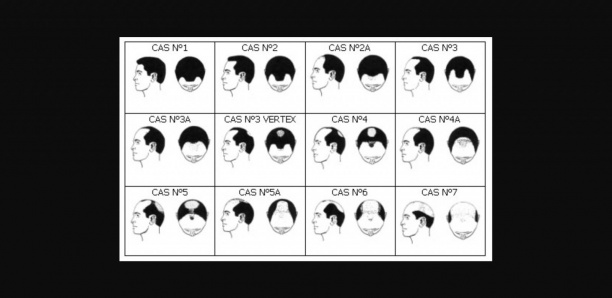 [Bulletin de santé 1/2] Calvitie, alopécie… : La coiffure indésirable !
