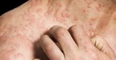 Urticaire : son impact sur le quotidien et la qualité de vie est sous-estimé